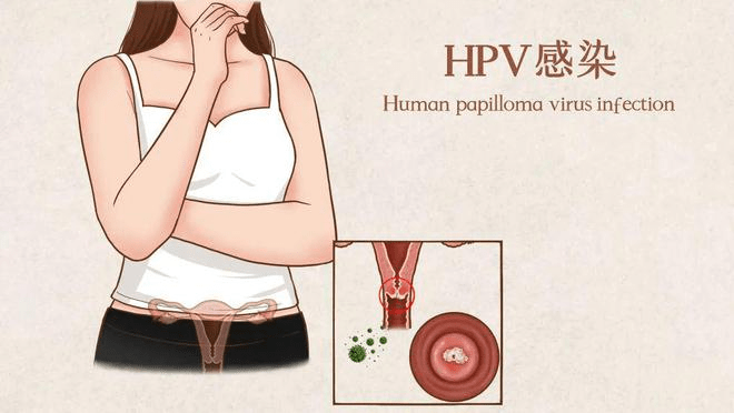 手机中病毒的症状:hpv病毒感染引起的湿疣有哪些症状？